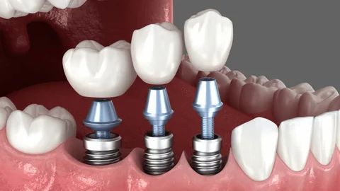Implantes Dentales de Titanio como funcionan