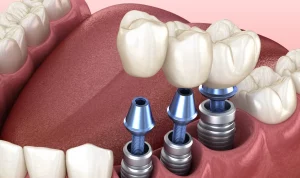 Implantes dentales de Titanio que son