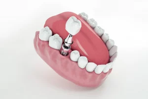 Implantes dentales de Carga Inmediata