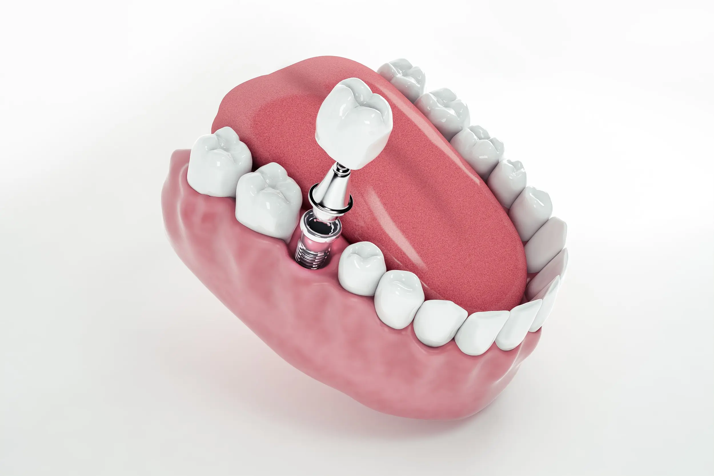 Implantes dentales de Carga Inmediata