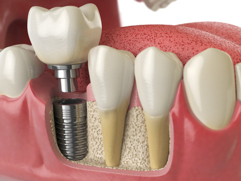 implantes de carga inmediata